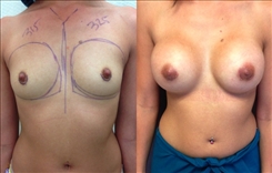 Breast Augmentation Patient Before & After Photo 1