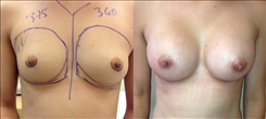 Breast Augmentation Patient Before & After Photo 1