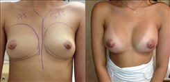 Breast Augmentation Patient Before & After Photo 1