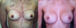 Breast Augmentation Patient Before & After Photo 1