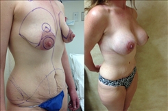 Breast Augmentation Patient Before & After Photo 1