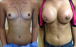 Breast Augmentation Patient Before & After Photo 1