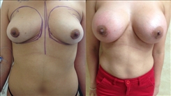 Breast Augmentation Patient Before & After Photo 1