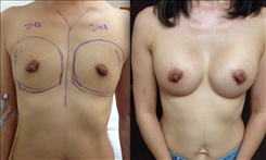 Breast Augmentation Patient Before & After Photo 1