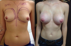 Breast Augmentation Patient Before & After Photo 1