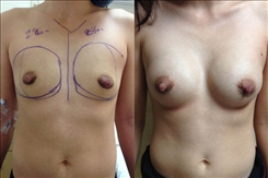 Breast Augmentation Patient Before & After Photo 1