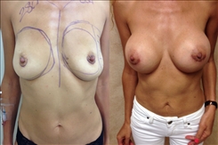 Breast Augmentation Patient Before & After Photo 1