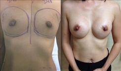 Breast Augmentation Patient Before & After Photo 1