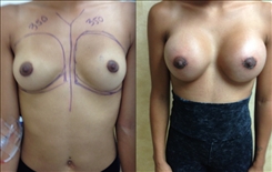 Breast Augmentation Patient Before & After Photo 1