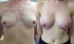 Breast Augmentation Patient Before & After Photo 1