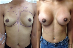 Breast Augmentation Patient Before & After Photo 1