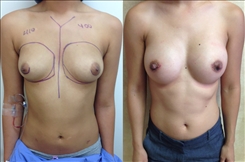Breast augmentation before and after with 410/400cc implants performed in Beverly Hills