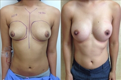 Breast Augmentation Patient Before & After Photo 1