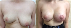 Breast Augmentation Patient Before & After Photo 1