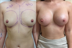 Breast augmentation before and after with 380/390cc implants performed in Beverly Hills
