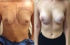 Breast augmentation before and after with 300/290cc implants performed in Beverly Hills