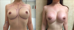 Breast augmentation before and after with 475cc implants performed in Beverly Hills