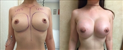 Breast Augmentation Patient Before & After Photo 1