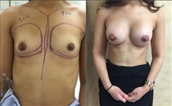 Breast augmentation before and after with 320cc implants performed in Beverly Hills