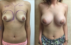 Breast augmentation before and after with 470cc implants performed in Beverly Hills