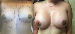 Breast Augmentation Patient Before & After Photo 1