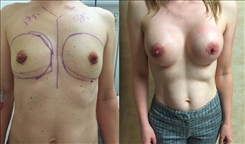 Breast Augmentation Patient Before & After Photo 1