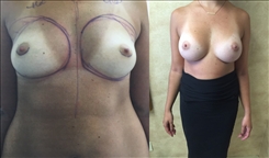 Breast Augmentation Patient Before & After Photo 1