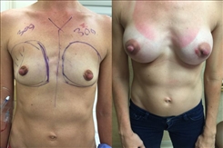 Breast Augmentation Patient Before & After Photo 1