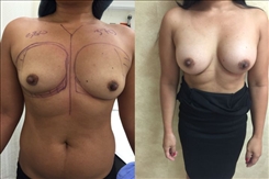 Breast Augmentation Patient Before & After Photo 1