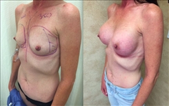 Breast Augmentation Patient Before & After Photo 1