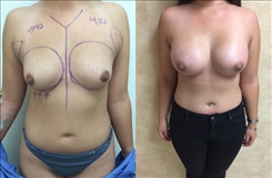 Breast Augmentation Patient Before & After Photo 1