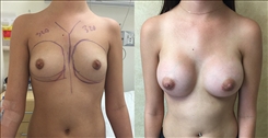 Breast Augmentation Patient Before & After Photo 1