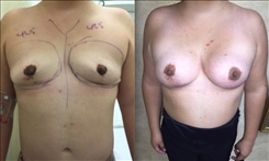 Breast Augmentation Patient Before & After Photo 1