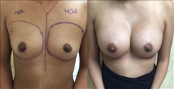 Breast Augmentation Patient Before & After Photo 1