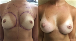 Breast Augmentation Patient Before & After Photo 1