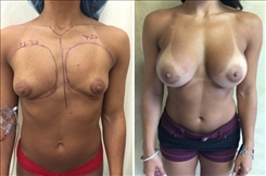 Breast Augmentation Patient Before & After Photo 1