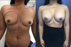 Breast Augmentation Patient Before & After Photo 1