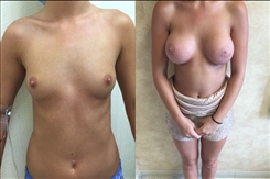 Breast Augmentation Patient Before & After Photo 1