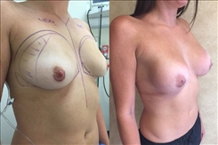 Breast Augmentation Patient Before & After Photo 1