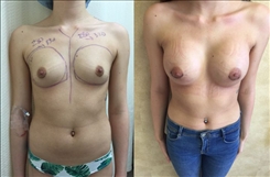 Breast Augmentation Patient Before & After Photo 1