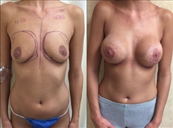 Breast Augmentation Patient Before & After Photo 1