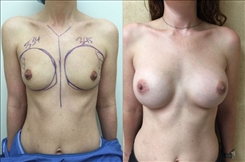 Breast Augmentation Patient Before & After Photo 1