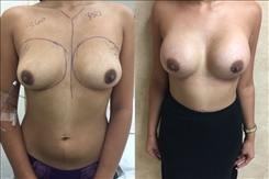 Breast Augmentation Patient Before & After Photo 1