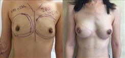 Breast Augmentation Patient Before & After Photo 1