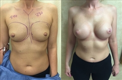 Breast Augmentation Patient Before & After Photo 1