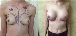 Breast Augmentation Patient Before & After Photo 1