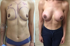 Breast Augmentation Patient Before & After Photo 1