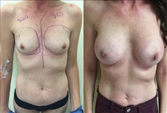 Breast Augmentation Patient Before & After Photo 1