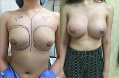 Breast Augmentation Patient Before & After Photo 1