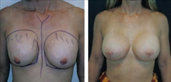 Breast Implant Revision Patient Before & After Photo 1